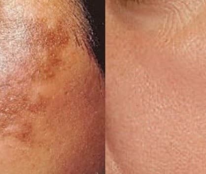 Before and After Skin Treatment Results